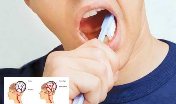 Focus On Dental Hygiene To Prevent Stroke