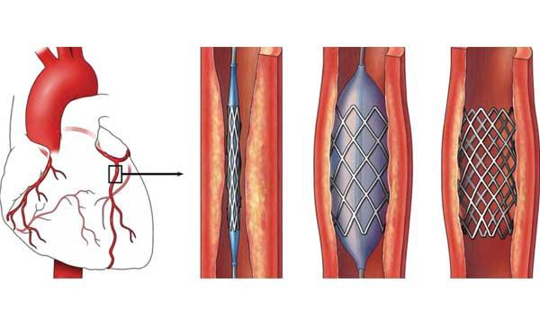 I Have A Stomach Ailment After Having Stents In My Arteries