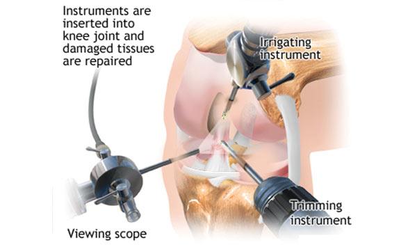 Knee Surgery For Arthritis Is Not Beneficial