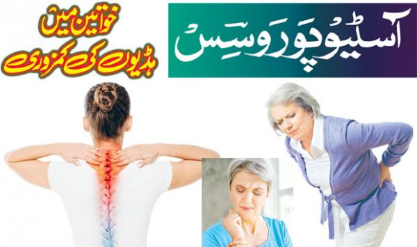 Osteoporosis Osteoporosis In Women