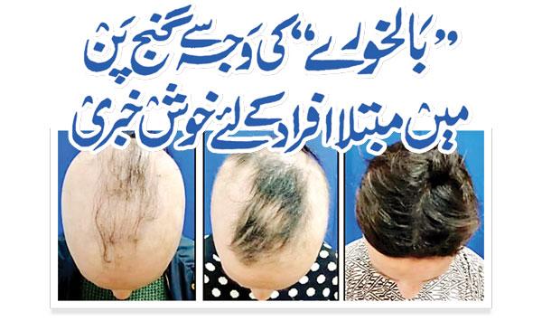 Good News For People Suffering From Baldness Due To Baldness