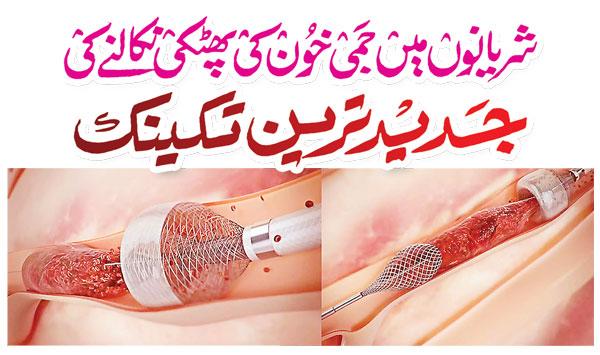 State Of The Art Technique For Removing Blood Clots From Arteries