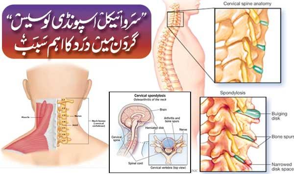 Cervical Spondylosis Is A Major Cause Of Neck Pain