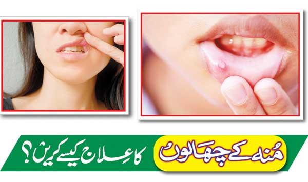 How To Treat Mouth Ulcers