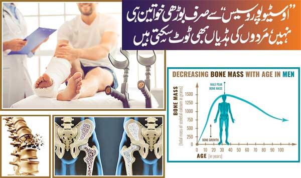 Osteoporosis Affects Not Only Old Women Men Can Also Break Their Bones