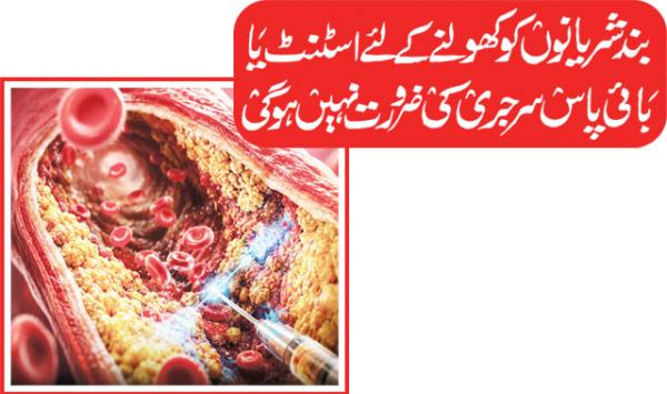 Stents Or Bypass Surgery Will Not Be Needed To Open Blocked Arteries