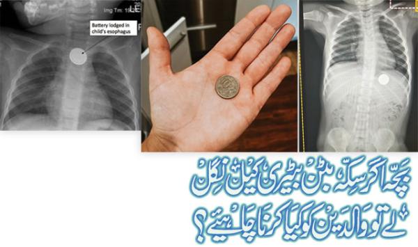 What Should Parents Do If A Child Swallows A Coin Button Battery Or Nail